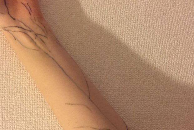 歯ぐきの手術の影響で、なぜか腕の血管がくっきり…。珍しいのでペンでなぞってみました(笑)
