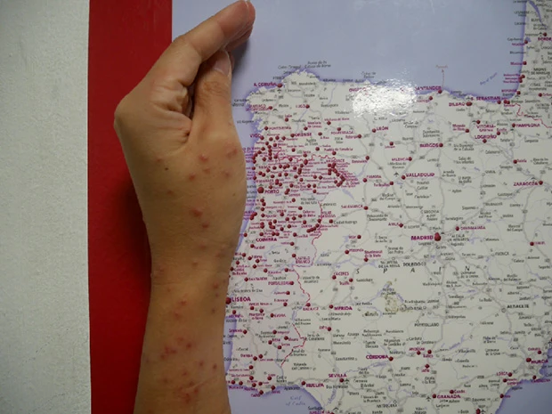 まるでヨーロッパを縦横する長距離バスの発着地点マークのような赤い発疹(これ比較的マシな時