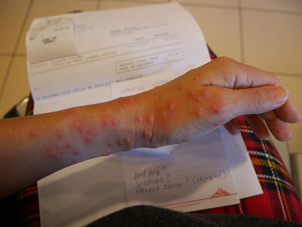 ブツブツの周りも皮膚がただれてブヨブヨっとしてます。しょぼん。この時はもう気が弱くなって心は泣いています。プチ鬱