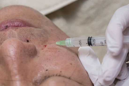 ほうれい線に肌細胞を移植する