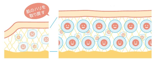 【老化現象が改善】 移植された肌細胞によって、肌のハリの素となるコラーゲンやヒアルロン酸が作り出される。それが少しずつ蓄積することで、肌にハリを取り戻す