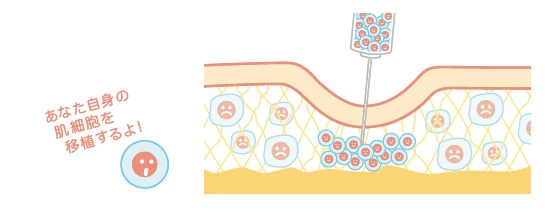 【肌細胞の移植】 紫外線によるダメージの少ない耳の裏から採取した皮膚から肌細胞を抽出・培養し、肌の衰えが気になる部位へ移植する
