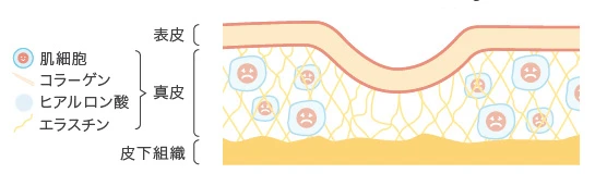 【老化した肌】 肌は表皮と真皮の2層になっている。加齢や紫外線のダメージなどにより、真皮層の肌細胞が減少。ヒアルロン酸やコラーゲン等を作り出す力の低下により真皮がもろく薄くなってしまい、肌のシワやたるみ、目の下にクマ、ほうれい線ができてしまう