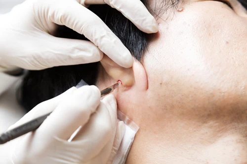 皮膚は耳の裏から採取する。大きさはだいたい米粒大くらいだ