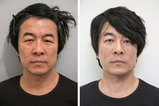 初回の施術前が左、施術後が右。早くも効果が出ているように見えるが、これは施術直後でやや腫れているため