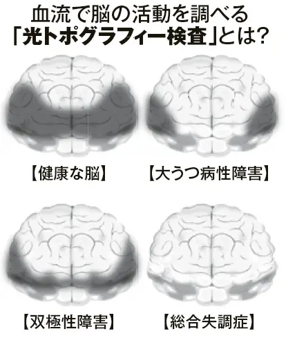 若年患者の ニュータイプ 抗うつ薬が効かない 双極性障害ｉｉ型 が増殖中 その治療法は ライフ 文化 ニュース 週プレnews 週刊プレイボーイのニュースサイト