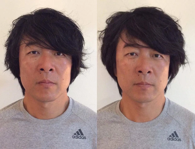 左が施術前、右が施術後。小顔になりスッキリとした印象に!