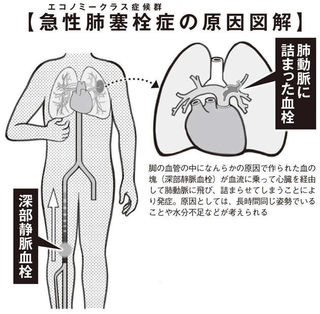 健康な人間でも突然発症する、若年性"急性肺塞栓症"の予兆とは?