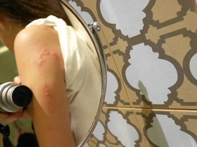 腕だいぶ派手にやられたなぁ。とてもカユイ