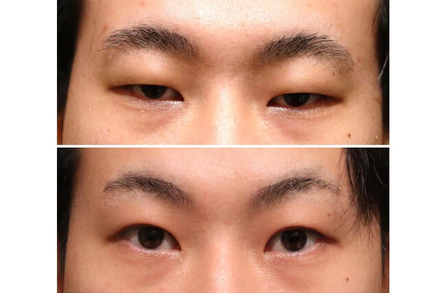 眼瞼下垂の手術前(上)と手術後。まぶたの開き度合いが変わるだけで、印象も大きく異なる