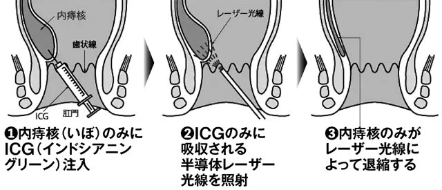 いぼ痔の新しい治療法「ICG併用半導体レーザー照射法」