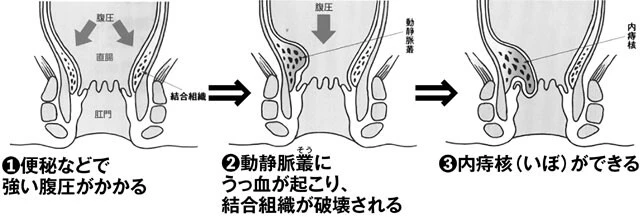 「いぼ痔」になる理由