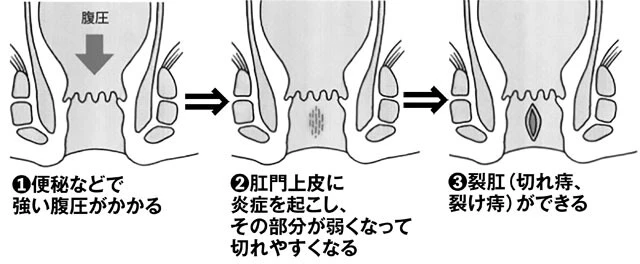 「切れ痔」になる理由