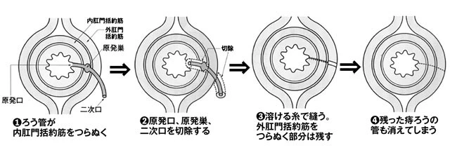 痔ろうの「括約筋温存」手術