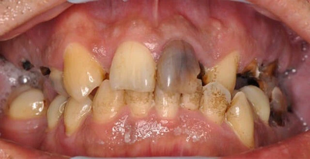 歯は抜け、いたるところに虫歯がある上、歯ぐきもぼこっと腫れあがってしまっている