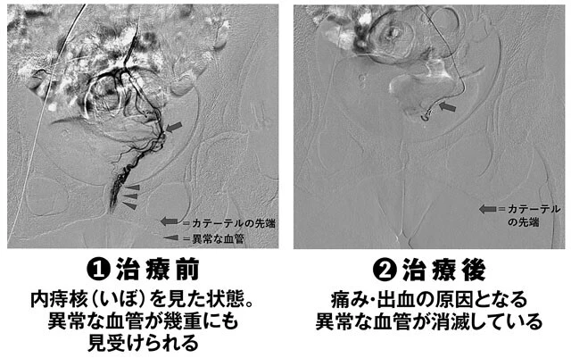 いぼ痔の「カテーテル（細い管）治療」
