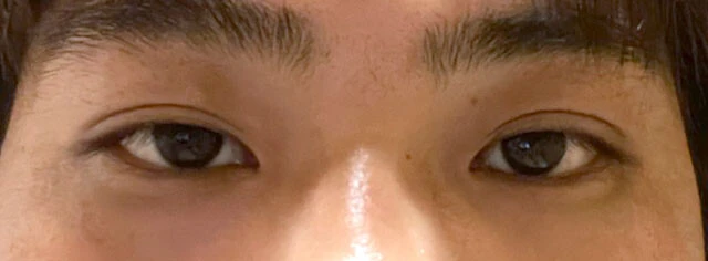 わずかに上まぶたが下がっていると指摘された編集者の目。30代半ばだが「おそらくまぶたの脂肪が多いため下がりやすい」とも