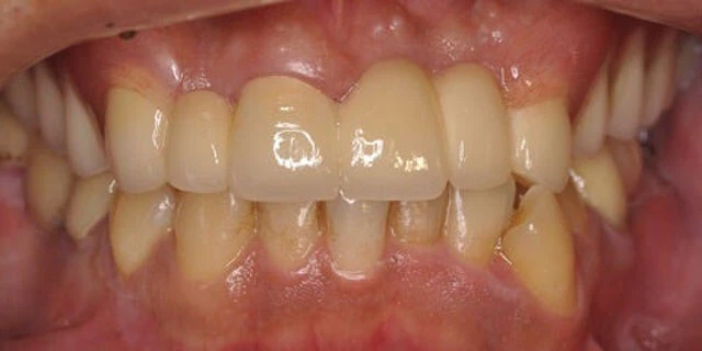 トップ画像の治療後。抜歯や根管治療、虫歯治療、歯周治療、インプラントなどさまざまな治療が必要なため、本人のモチベーションが大事になる