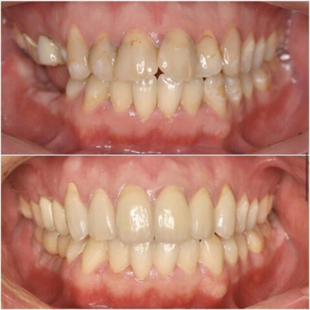 無痛リラクゼーション治療+インプラント+セラミック治療の組み合わせで、健康的な歯を残して治療することも
