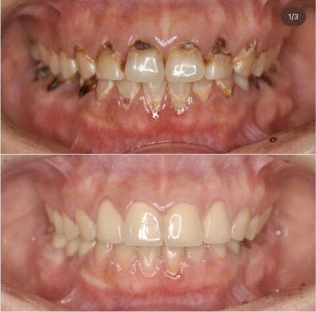 奥歯は抜け、ほぼすべての歯が虫歯になってしまった患者のビフォーアフター