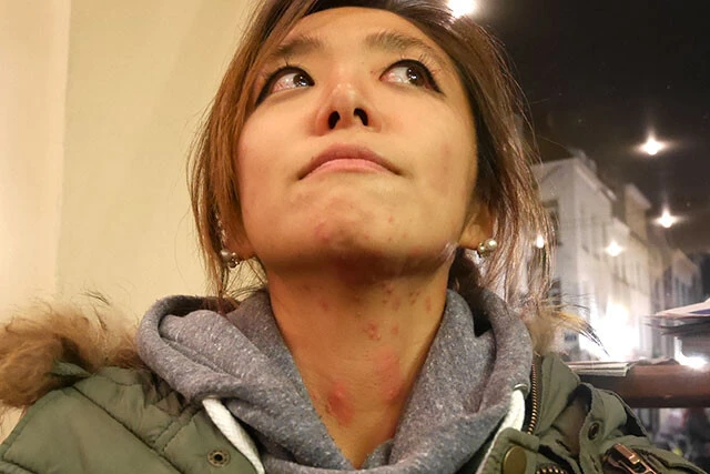 パリにて。南京虫被害も場合によっては死に至る。日本でも最近流行ってるとか...。怖。