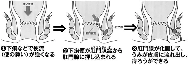 「痔ろう」になる理由