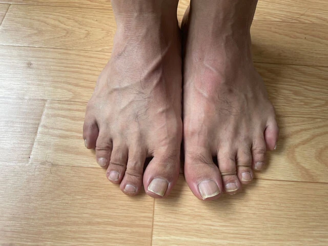 軽度の外反母趾、内反小趾、横を向く寝指軽度のハンマートゥになっている記者の足。おそらく長年、大きめの靴を履き、靴紐をきちんと縛らず、靴の中で足が滑っていたため、さまざまな変形を起こしたと思われる