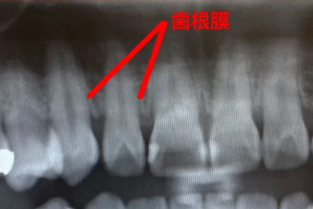 歯と骨を結び付ける歯根膜。厚さ0.3㎜の繊維組織で、歯ごたえなど刺激を感知している