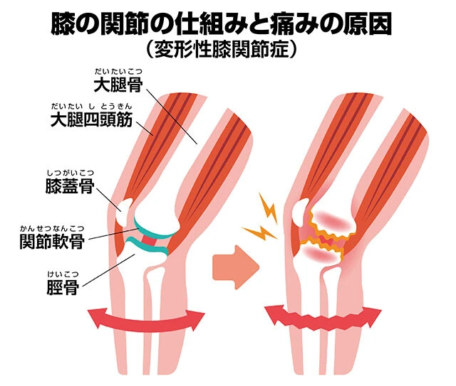 変形性膝関節症は、加齢による筋力の低下などで関節軟骨が擦り減り、大腿骨と脛骨がぶつかり合うことにより痛みが生じる