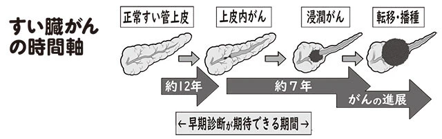 上皮内がんができてすい管の幅が広がるところから転移までは約7年。がんにかかっても最初の2、3年の間は早期発見のチャンスあり