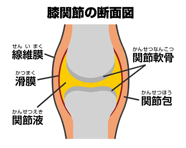膝に水がたまるというのは、炎症などで関節液の滑膜外への排出がうまくいかず、産生量が増えることで起こるもの