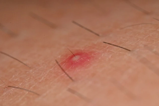 自分で処理する際には毛穴トラブルに注意！