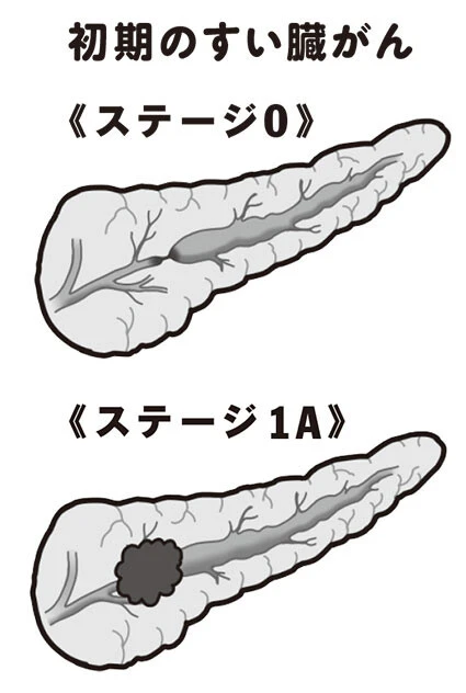 初期といわれる《ステージ0》はがんがすい管の中にとどまっている状態。《ステージ1A》はがんがすい管を飛び出してはいるが、すい臓の中にとどまっている段階でがんの直径が2㎝以下のもの