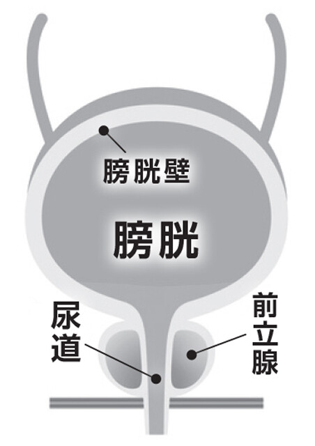 前立腺肥大症が進行すると、尿意切迫を感じることも