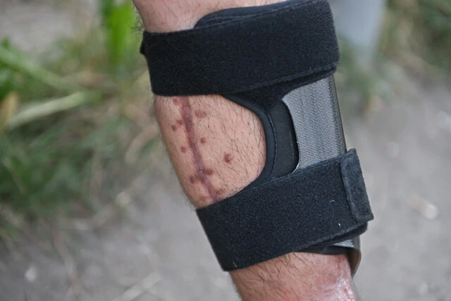 被弾時の体勢から大ケガは左脚に集中。全身で百数十針の手術となり、さらに爆弾の破片などが40ヵ所以上に刺さっていた