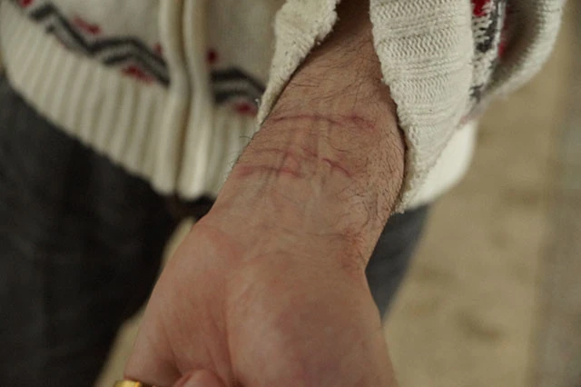 再収容後、自殺を図ったときの傷痕