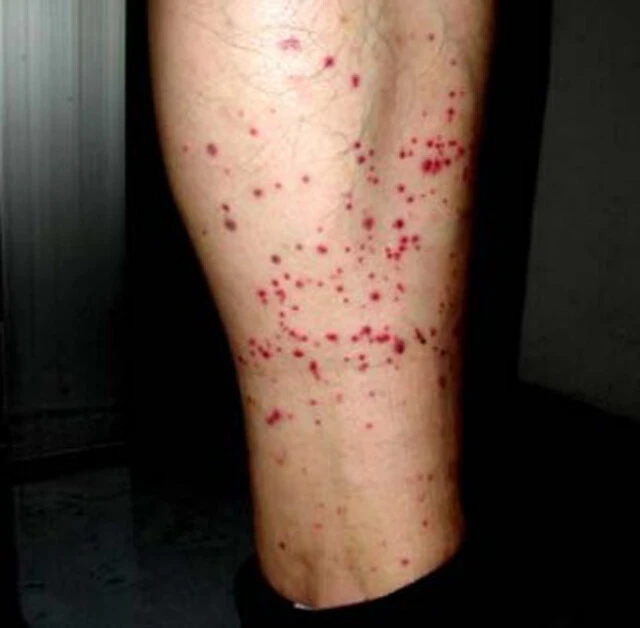 トコジラミに何度も吸血された人の脚(写真提供/豊島区池袋保健所)