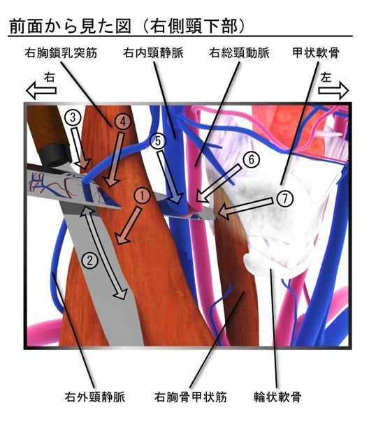 鑑定書には文字で以下のように書かれる。1.右胸鎖乳突筋外側を刃の面を筋肉に沿う方向に向けて浅く切傷2.創洞長7cm程度以下3.右外頸静脈を切断4.右胸鎖乳突筋表層をほぼ筋の走行(斜め前下方)に沿い貫通……。上のようなCGによる補助説明がなければ、シロウトの裁判員にはイメージがわかない。(C)瀬尾拡史